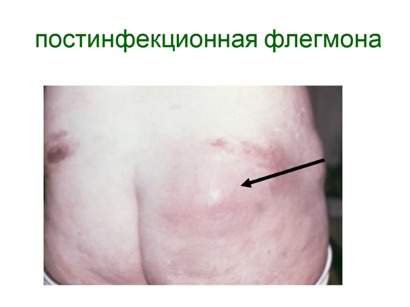 постинфекционная флегмона